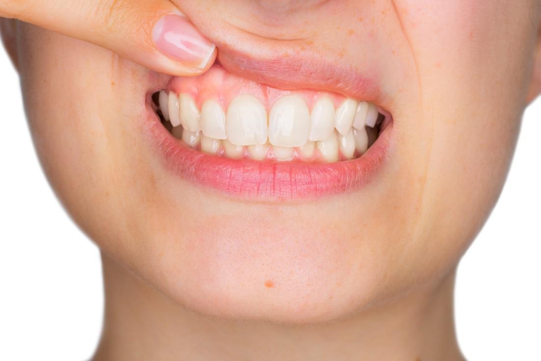 What is the Best Way to Treat Receding Gums?