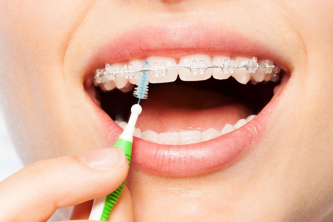 5 Tips for Cleaning with Braces