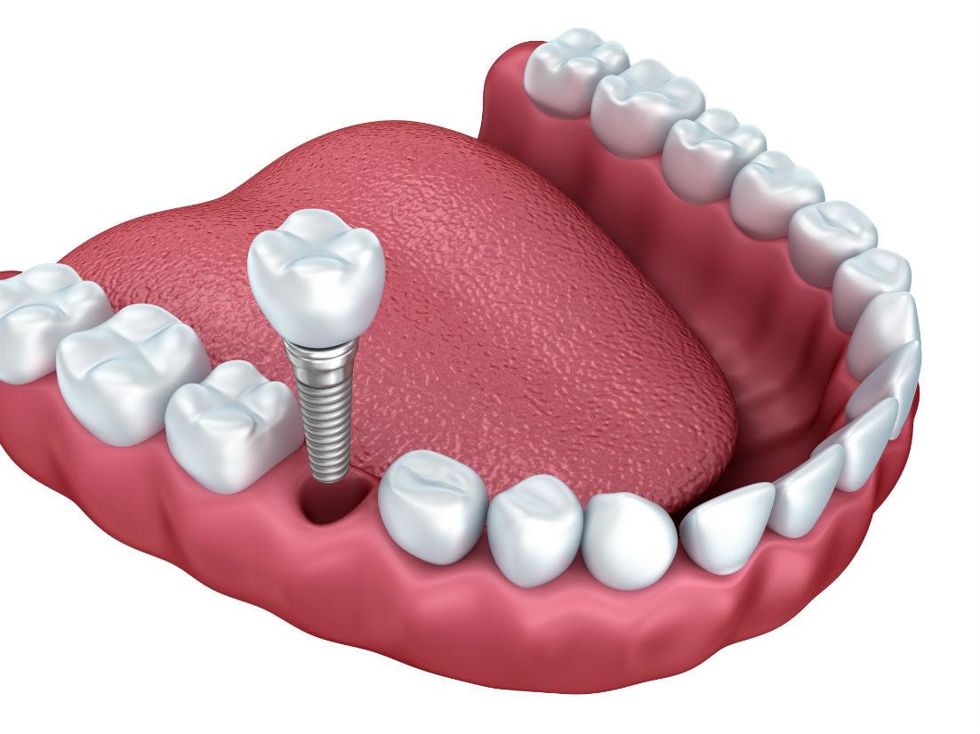 Dental Implants Downey CA