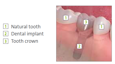 Dental Implants Downey CA