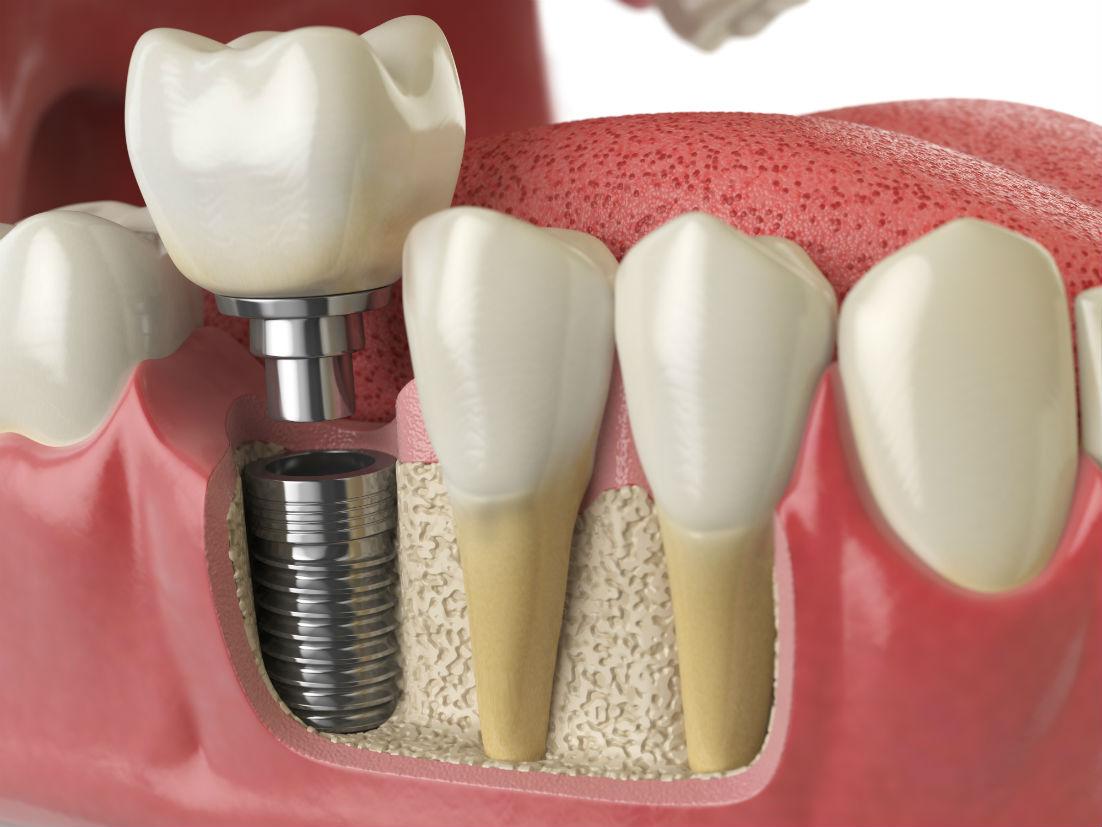 Dental Implants Downey CA
