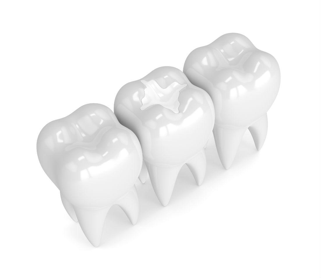 What are Dental Sealants and How Do They Protect Teeth from Cavities?