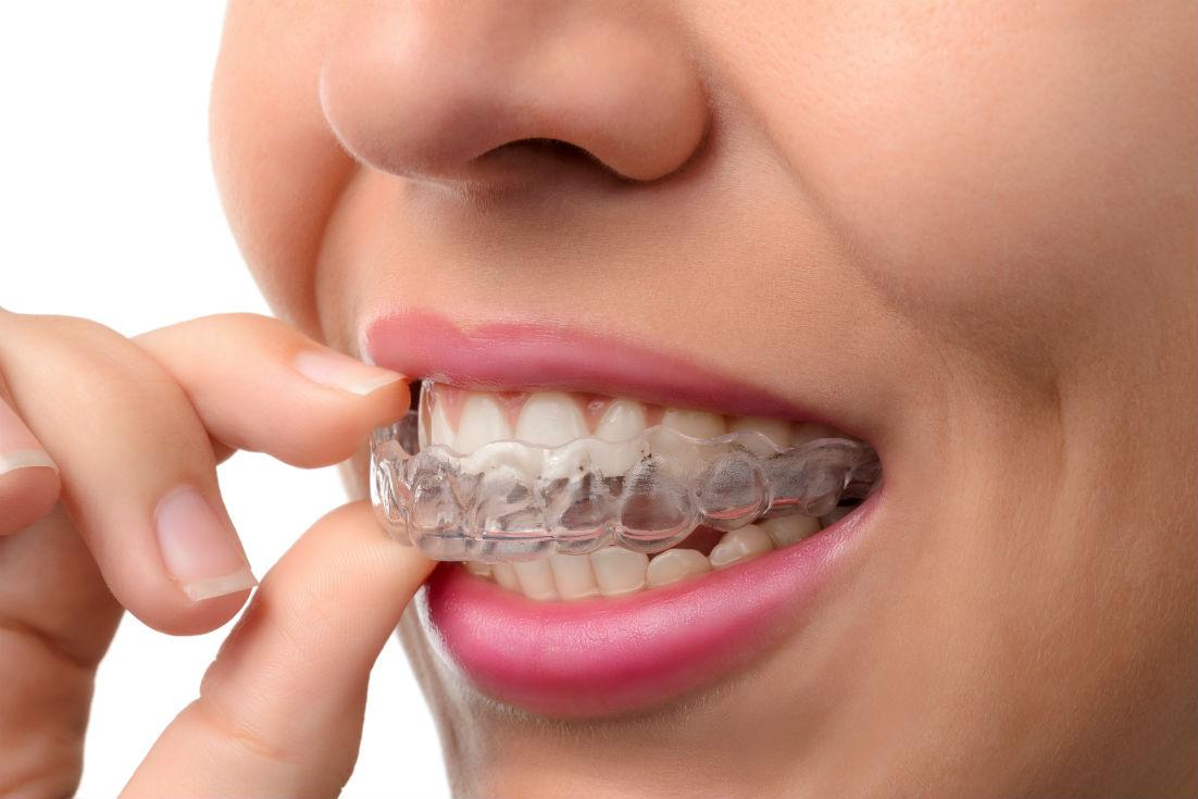 Invisalign Downey CA