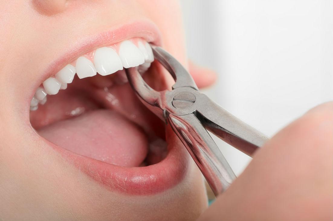 How to Prepare for a Tooth Extraction