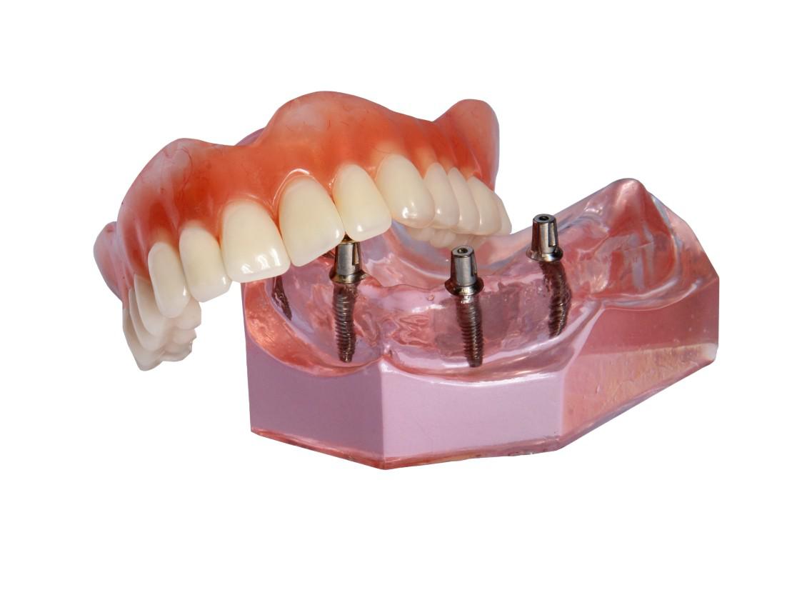 Dental Implants Downey, CA